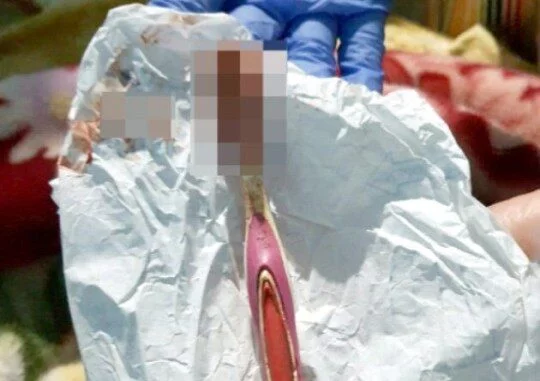 Doctors Remove Toothbrush From A Man’s Stomach After Swallowing It Whiles Brushing
