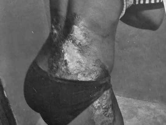 Trader Pours Hot Water On Daughter for Allegedly Stealing Her ¢5 for food 1 Crime Court Harm 1