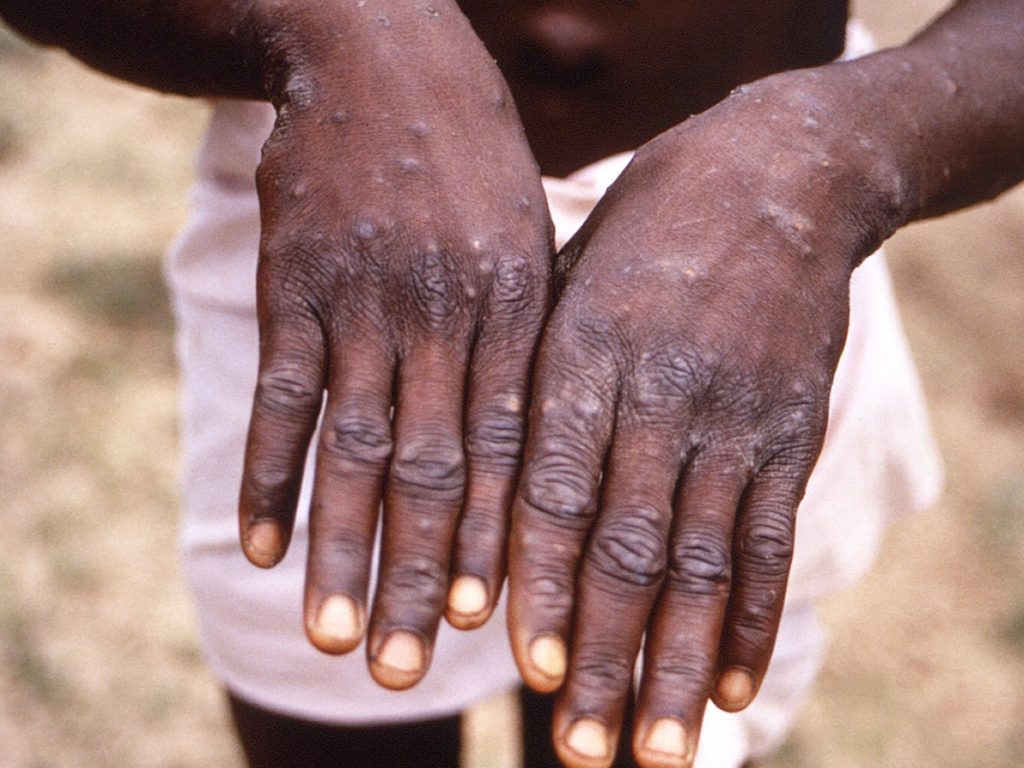 who sees no reason for alarm over monkeypox