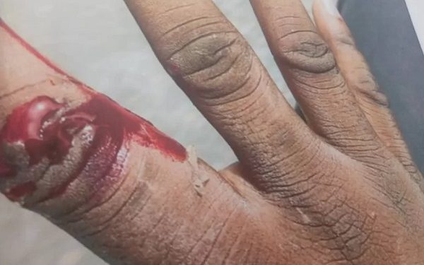 driver jailed 9 months for biting cops fingers