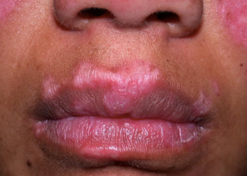 Patient living with Lupus disease shares story on Joy FM’s ‘Ultimate Health’