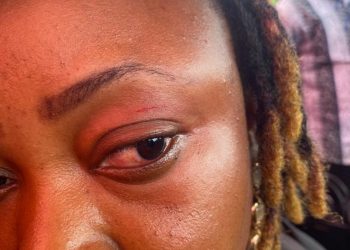 Agotime Ziope DCE attacks NPP’s Dzifa Kaledzi; leaves her with an eye injury