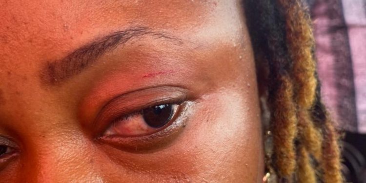 agotime ziope dce attacks npps dzifa kaledzi leaves her with an eye injury