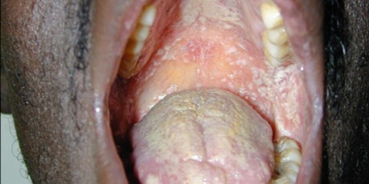 kwesi yankah o r a l cavities