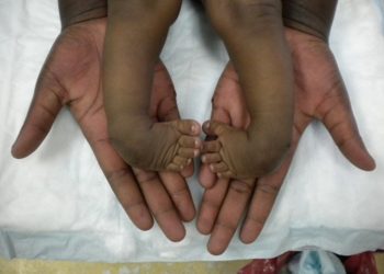 Clubfoot children not cursed, condition treatable – Brazza International Foundation