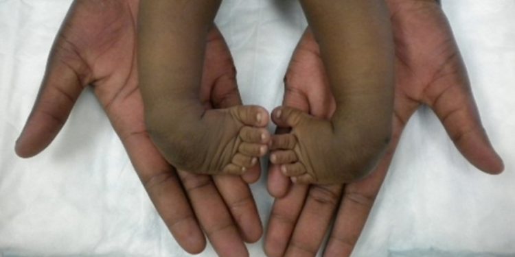 clubfoot children not cursed condition treatable brazza international foundation