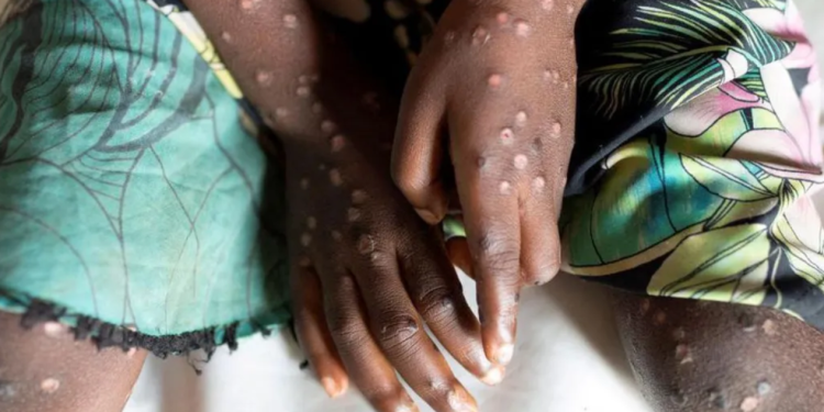 congo faces setback in mpox response after rwanda backed rebels advance in the east