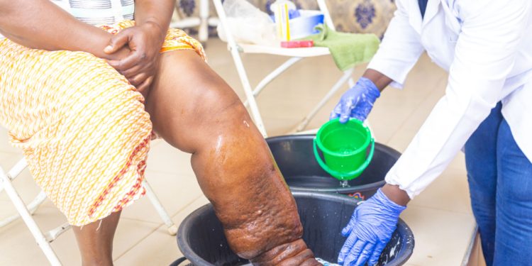 knust study links poor nutrition to worsening lymphatic filariasis