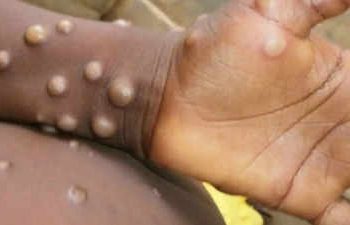 GHS takes measures to check Mpox outbreak