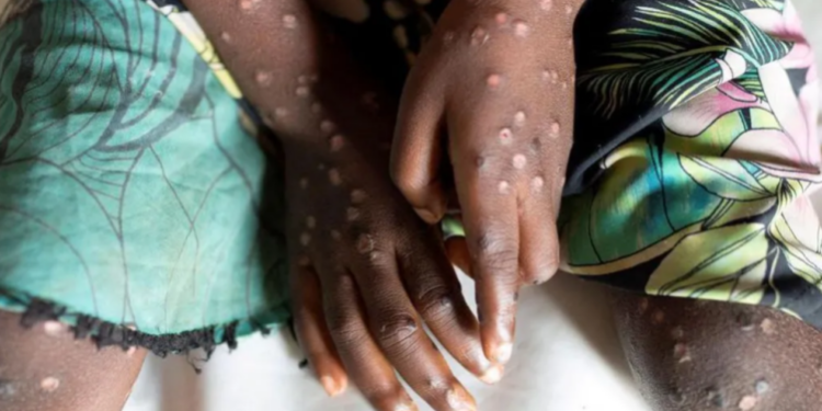 mpox cases in ghana reaches 9 ghs