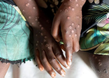 Mpox cases increase to 4 – Ghana Health Service