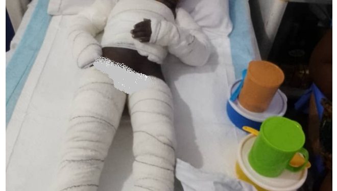 mother and children suffer severe burns appeal for support for life saving treatment