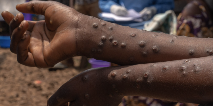 six new mpox cases confirmed in ghana total rises to 91