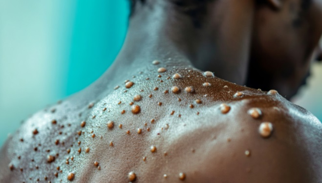 ghana records 30 more mpox cases total now 163