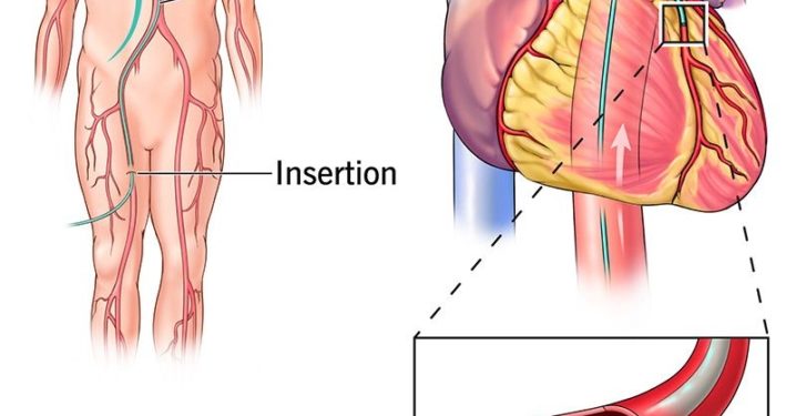 kath doctor dies over lack of laboratory for treating heart attack