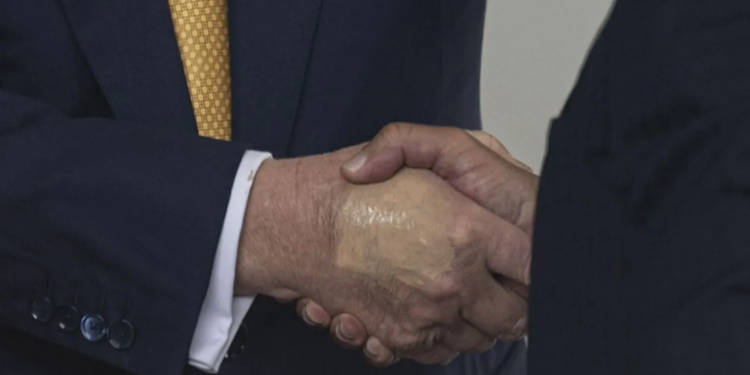 white house says trump diagnosed with vein condition after questions about bruises