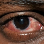 Don’t use breast milk for eye treatment –Optometrist advises 4 Don’t use breast milk for eye treatment –Optometrist advises