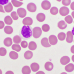 Joy Cancer Awareness Month: Expert warns parents on early signs and treatment of childhood leukaemia