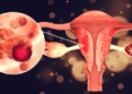 Joy Cancer Awareness Month: Understanding the risks, diagnosis and treatment of Ovarian Cancer