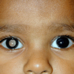Joy Cancer Awareness Month: What you should know about retinoblastoma in children 5 Joy Cancer Awareness Month: What you should know about retinoblastoma in children