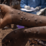 Mpox fatalities rise to six as GHS sounds alarm over festive crowds