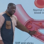 Sickle cell is not sexually transmitted – Haematologist debunks myths 3 Sickle cell is not sexually transmitted – Haematologist debunks myths
